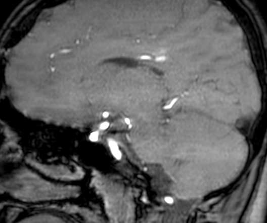 Cerebral arteriovenous malformation at posterior body of corpus callosum (Radiopaedia 74111-84925 J 165).jpg