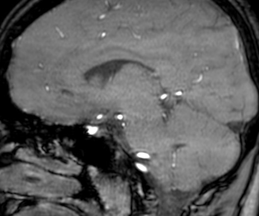 Cerebral arteriovenous malformation at posterior body of corpus callosum (Radiopaedia 74111-84925 J 217).jpg