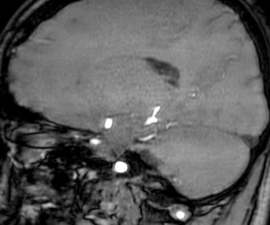 Cerebral arteriovenous malformation at posterior body of corpus callosum (Radiopaedia 74111-84925 J 248).jpg