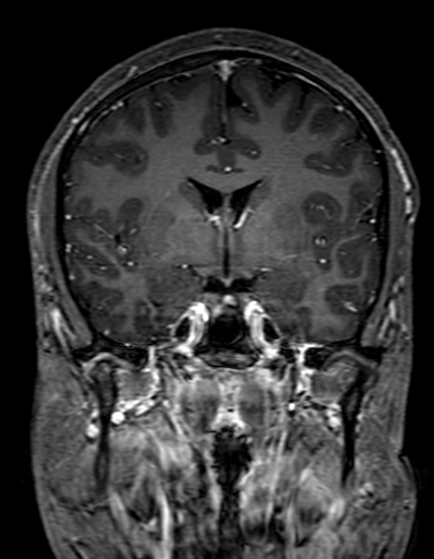 Cerebral arteriovenous malformation at posterior body of corpus callosum (Radiopaedia 74111-84925 K 160).jpg
