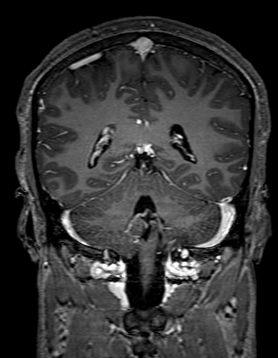 Cerebral arteriovenous malformation at posterior body of corpus callosum (Radiopaedia 74111-84925 K 249).jpg