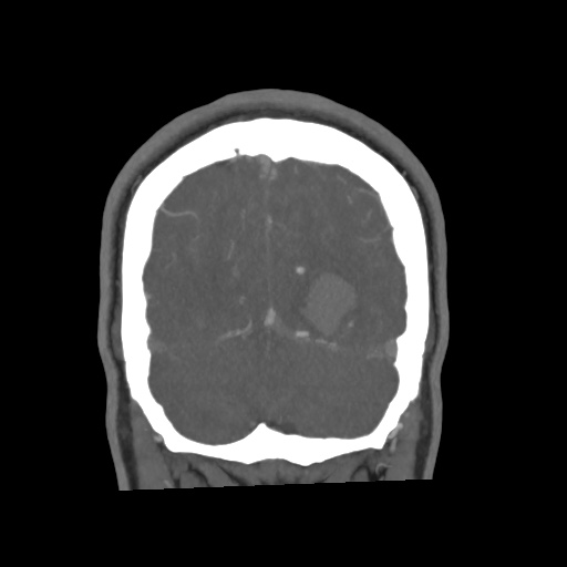 Cerebral arteriovenous malformation with lobar hemorrhage (Radiopaedia 35598-57216 C 78).jpg