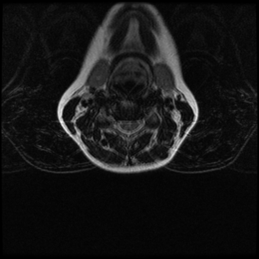 File:Cerebral autosomal dominant arteriopathy with subcortical infarcts and leukoencephalopathy (CADASIL) (Radiopaedia 41018-43763 Ax T2 C2-T1 10).png