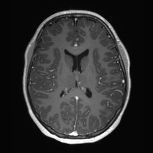 Cerebral cavernous venous malformation (Radiopaedia 70008-80021 Axial T1 C+ 44).jpg