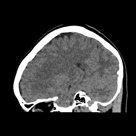 File:Cerebral cavernous venous malformation (Radiopaedia 70008-80022 C 20).jpg
