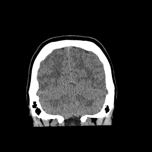 Cerebral cavernous venous malformation (Radiopaedia 70008-80022 non-contrast 57).jpg