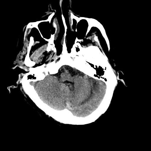 File:Cerebral contusions, subarachnoid hemorrhage and subdural hygromas (Radiopaedia 55399-61830 Axial non-contrast 7).png