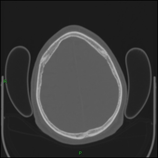Cerebral contusions (Radiopaedia 33868-35039 Axial bone window 170).jpg