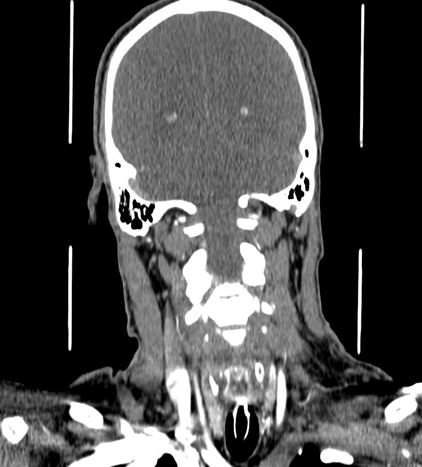 Cerebral edema in an overdose patient (Radiopaedia 72005-82539 B 109).jpg