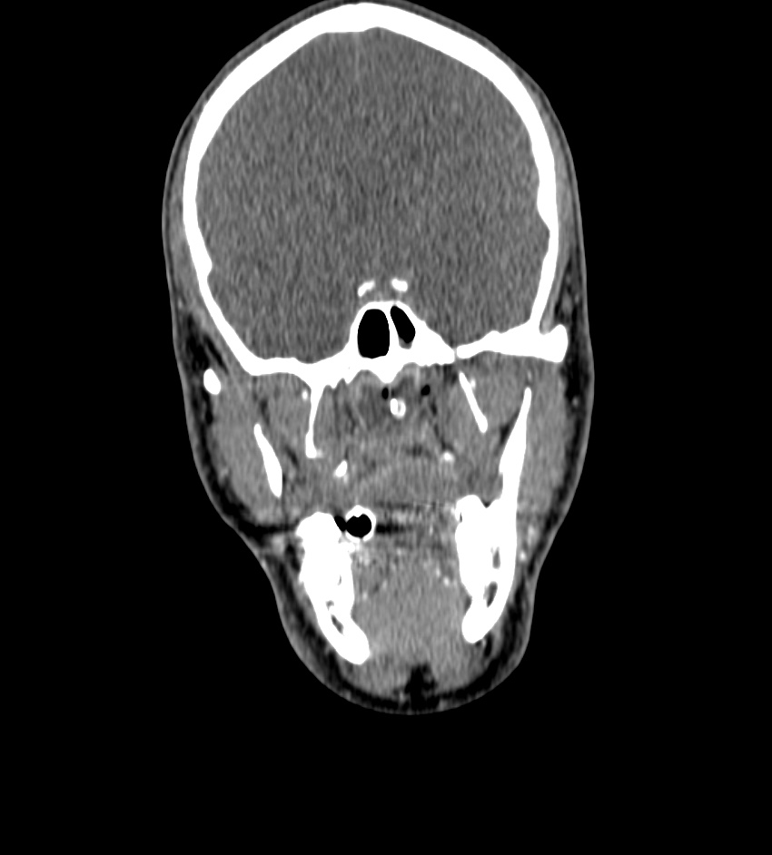 Cerebral edema in an overdose patient (Radiopaedia 72005-82539 B 11).jpg