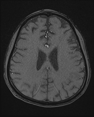Cerebral embolic infarcts (embolic shower) (Radiopaedia 72391-82921 Axial MRA 134).jpg