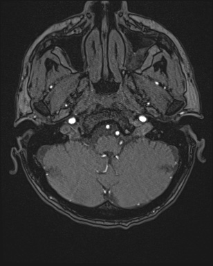 Cerebral embolic infarcts (embolic shower) (Radiopaedia 72391-82921 Axial MRA 4).jpg