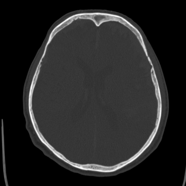 Cerebral hemorrhagic contusions (Radiopaedia 23145-23188 Axial bone window 33).jpg