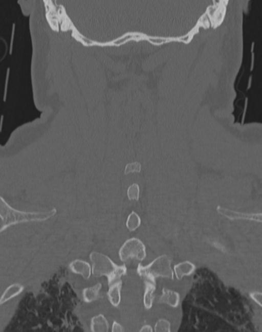 Cerebral hemorrhagic contusions and cervical spine fractures (Radiopaedia 32865-33841 Coronal bone window 59).jpg
