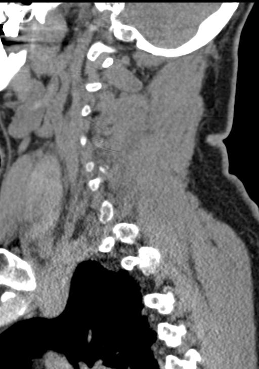Cerebral hemorrhagic contusions and cervical spine fractures (Radiopaedia 32865-33841 G 79).jpg