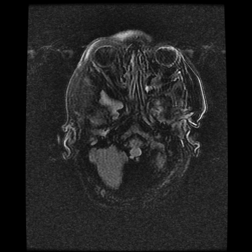 File:Cerebral manifestations of mucopolysaccharidosis type I (Radiopaedia 59171-66487 Axial FLAIR 2).jpg