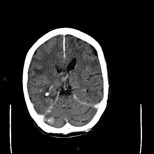 Cerebral metastases - breast primary (Radiopaedia 77653-89857 Axial C+ delayed 64).jpg