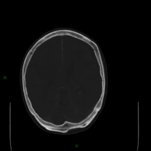 Cerebral metastases - breast primary (Radiopaedia 77653-89857 Axial bone window 70).jpg