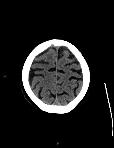 Cerebral metastases - ependymal and parenchymal (Radiopaedia 79877-93131 Axial non-contrast 67).jpg