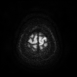 File:Cerebral metastases - melanoma (Radiopaedia 80972-94522 Axial DWI 60).jpg