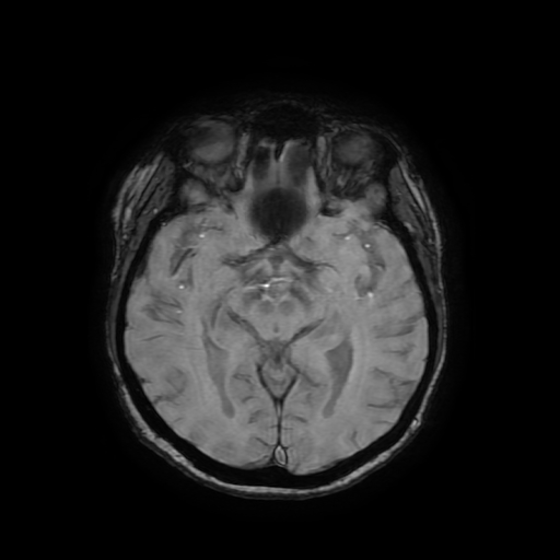 Cerebral metastases - melanoma (Radiopaedia 80972-94522 Axial SWI 45).jpg