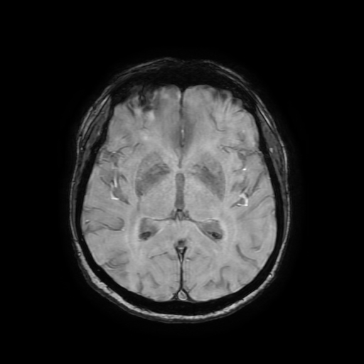 Cerebral metastases - melanoma (Radiopaedia 80972-94522 Axial SWI 51).jpg