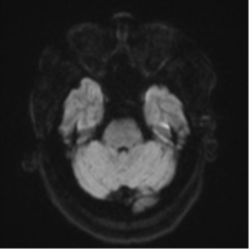 File:Cerebral metastases mimicking multifocal glioblastoma (Radiopaedia 50843-56353 Axial DWI 36).png