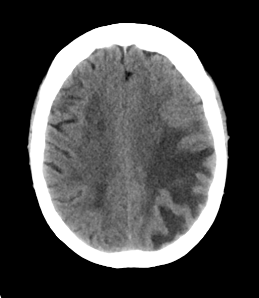 File:Cerebral metastasis (Radiopaedia 46744-51247 Axial non-contrast 21).png