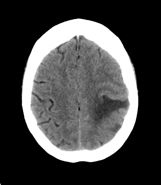File:Cerebral metastasis (Radiopaedia 46744-51247 Axial non-contrast 23).png