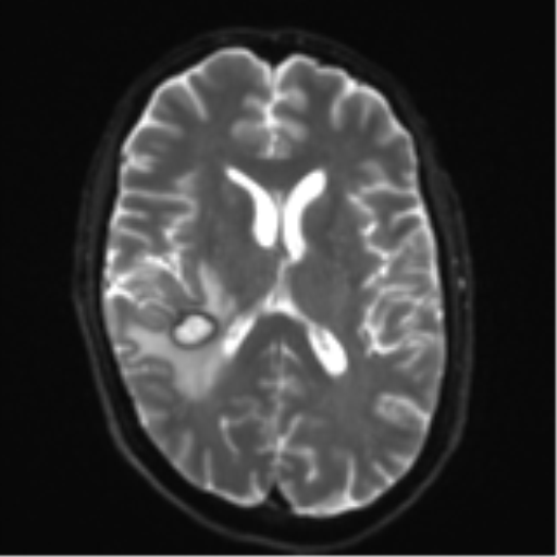 Cerebral metastasis - melanoma (Radiopaedia 54718-60954 Axial DWI 17).png
