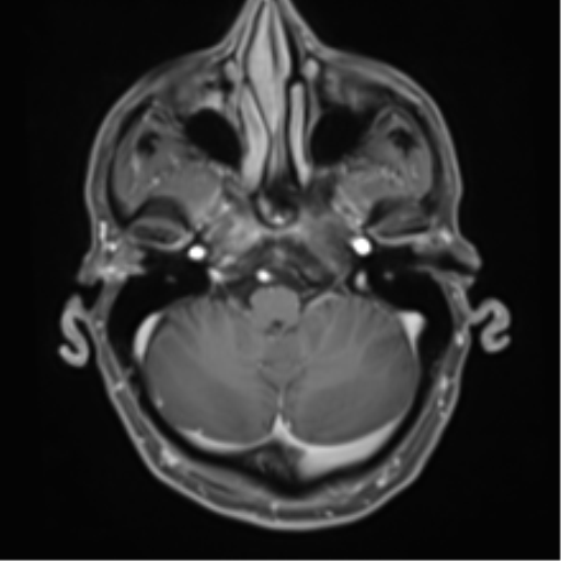 Cerebral metastasis - melanoma (Radiopaedia 54718-60954 Axial T1 C+ fat sat 12).png