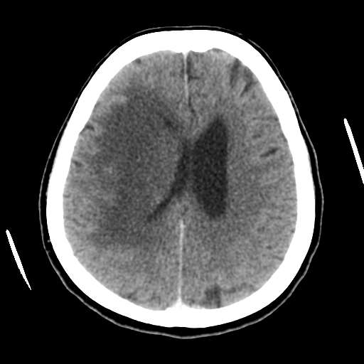 Cerebral metastasis to basal ganglia (Radiopaedia 81568-95412 Axial C+ delayed 39).png