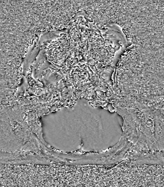 Cerebral metastasis to basal ganglia (Radiopaedia 81568-95413 Axial SWI phase 12).png