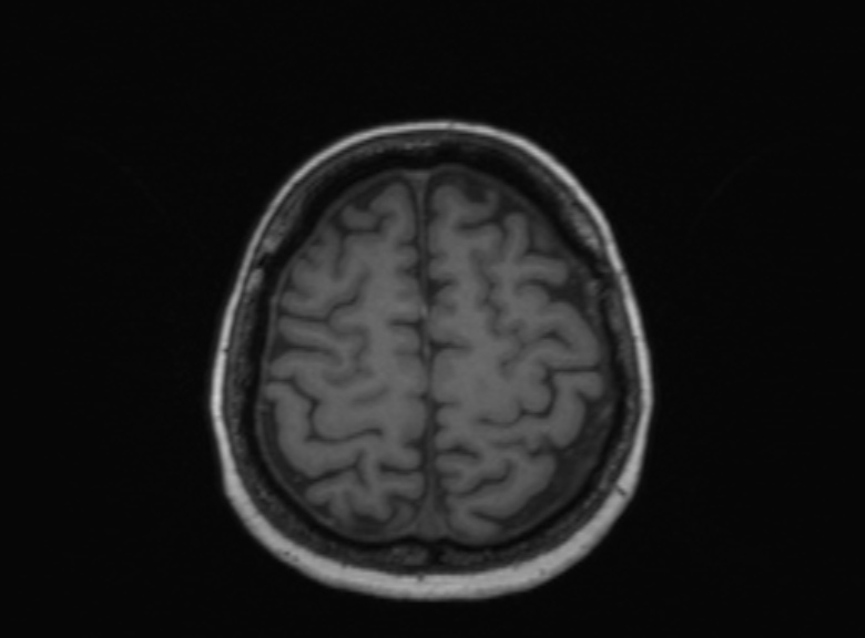 Cerebral ring enhancing lesions - cerebral metastases (Radiopaedia 44922-48817 Axial T1 142).jpg