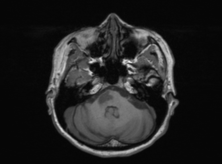 Cerebral ring enhancing lesions - cerebral metastases (Radiopaedia 44922-48817 Axial T1 302).jpg
