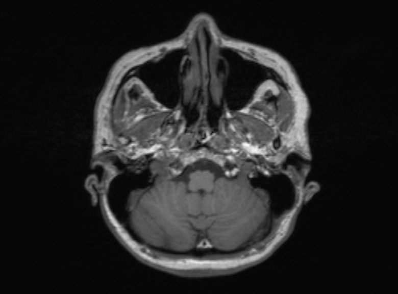 Cerebral ring enhancing lesions - cerebral metastases (Radiopaedia 44922-48817 Axial T1 327).jpg
