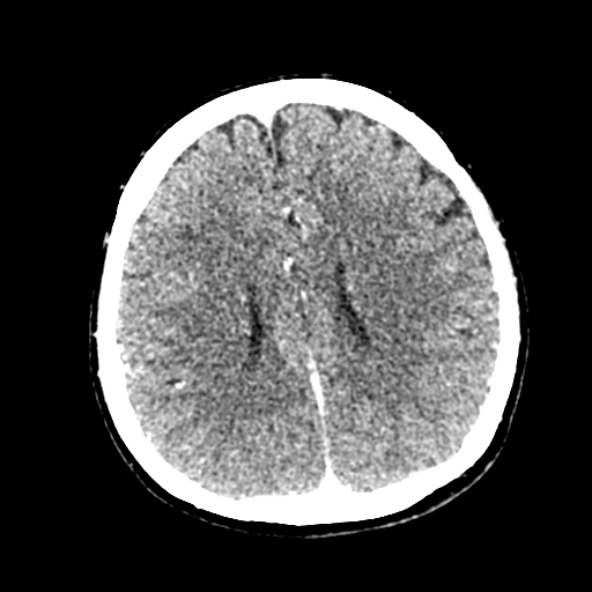 Cerebral ring enhancing lesions - cerebral metastases (Radiopaedia 44922-48818 B 184).jpg
