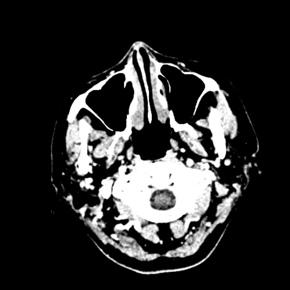 Cerebral ring enhancing lesions - cerebral metastases (Radiopaedia 44922-48818 B 6).jpg