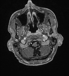 Cerebral toxoplasmosis (Radiopaedia 43956-47461 Axial T1 C+ 2).jpg