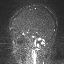 Cerebral tuberculosis with dural sinus invasion (Radiopaedia 60353-68090 Sagittal MRV 99).jpg