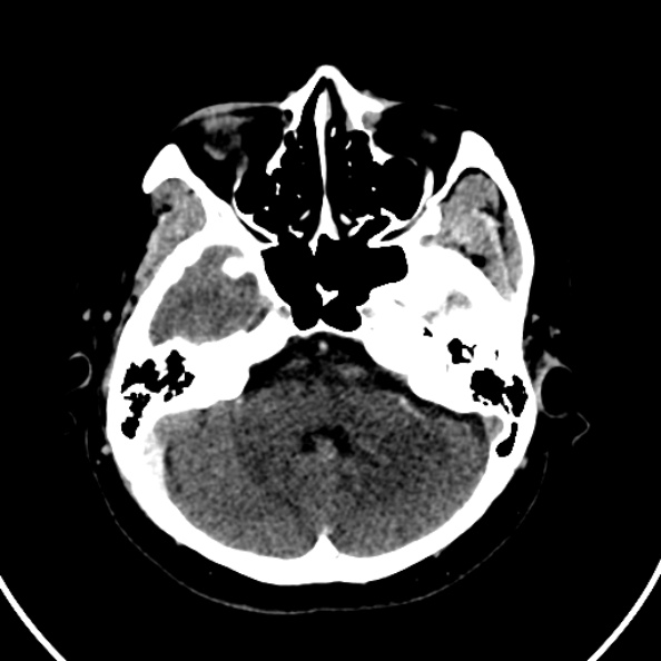 Cerebral venous hemorrhagic infarct from venous sinus thrombosis (Radiopaedia 55433-61883 Axial C+ delayed 113).jpg