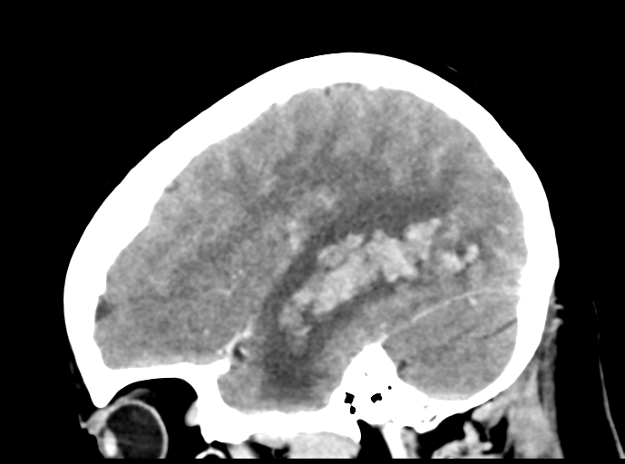 Cerebral venous hemorrhagic infarction (Radiopaedia 57576-64538 Sagittal C+ 16).png