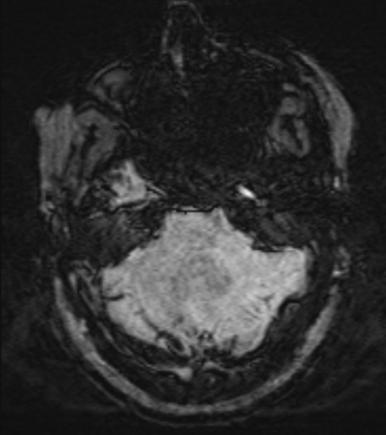 Cerebral venous infarct (Radiopaedia 53627-59685 Axial SWI 11).jpg