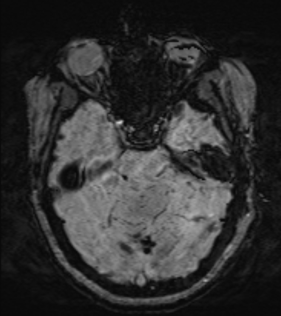 Cerebral venous infarct (Radiopaedia 53627-59685 Axial SWI 16).jpg