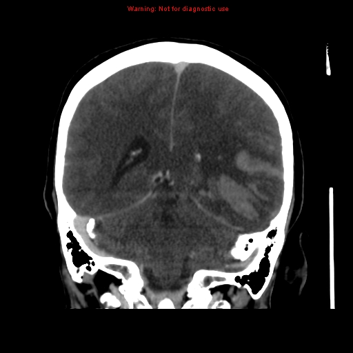 Cerebral venous infarction (Radiopaedia 12404-20735 B 54).jpg