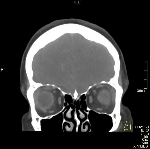 File:Cerebral venous sinus thrombosis (Radiopaedia 91329-108965 Coronal venogram 18).jpg