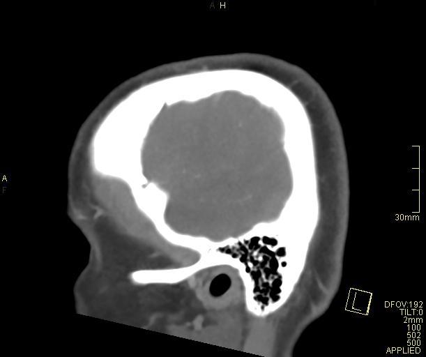 File:Cerebral venous sinus thrombosis (Radiopaedia 91329-108965 Sagittal venogram 10).jpg