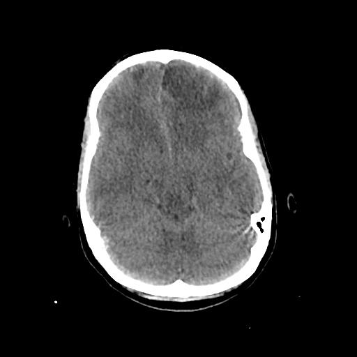 Cerebral venous throbmosis - hemorrhagic venous infarction (Radiopaedia 87318-103613 Axial non-contrast 60).jpg
