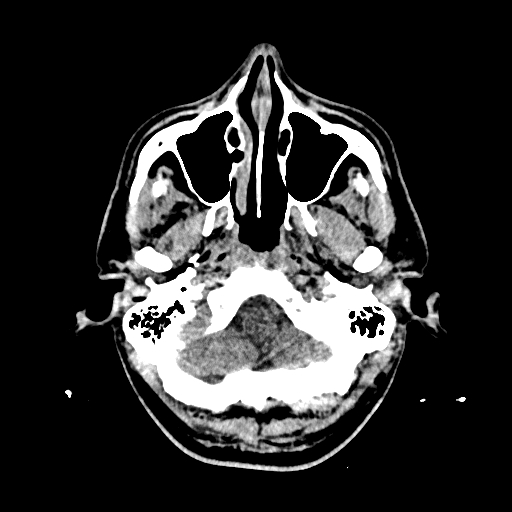 File:Cerebral venous thrombosis (CVT) (Radiopaedia 77524-89685 Axial non-contrast 5).jpg