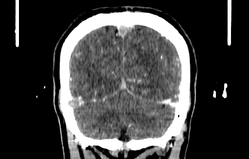 File:Cerebral venous thrombosis (CVT) (Radiopaedia 77524-89685 C 52).jpg